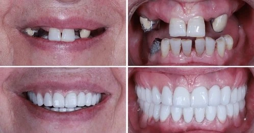 dental implants near you