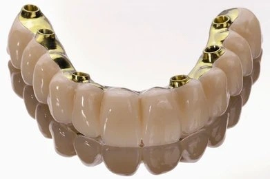 dental implants