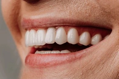 dental bridges near you