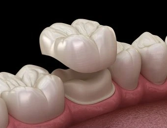 dental crowns in fort myers fl