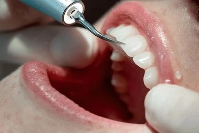 teeth cleanings in fort myers fl